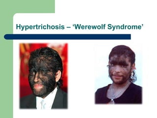Hypertrichosis – ‘Werewolf Syndrome’