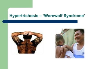 Hypertrichosis – ‘Werewolf Syndrome’