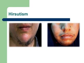Hirsutism