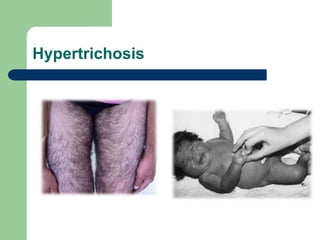 Hypertrichosis