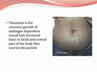  Hirsutism is the
excessive growth of
androgen dependent
sexual hair (terminal
hair) in facial and central
part of the body that
worries the patient
 