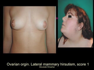 Ovarian orgin. Lateral mammary hirsutism, score 1
Aboubakr Elnashar
 