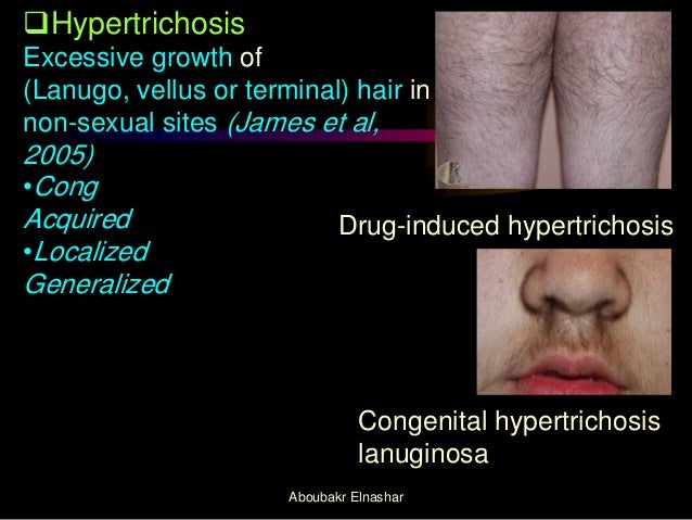 Hirsutism