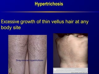 .
Hirsutism is a consequence of several factors
1.Androgen production
2. The sensitivity of the androgen receptors at
the ...
