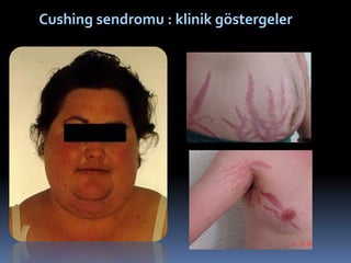Cushing sendromu : klinik göstergeler
 