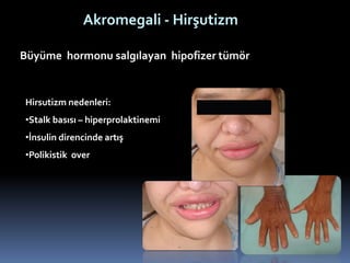 Akromegali - Hirşutizm
Büyüme hormonu salgılayan hipofizer tümör
Hirsutizm nedenleri:
•Stalk basısı – hiperprolaktinemi
•İnsulin direncinde artış
•Polikistik over
 