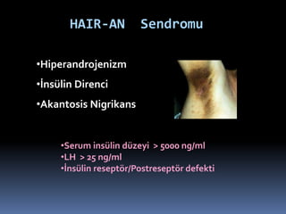 HAIR-AN Sendromu
•Hiperandrojenizm
•İnsülin Direnci
•Akantosis Nigrikans
•Serum insülin düzeyi > 5000 ng/ml
•LH > 25 ng/ml
•İnsülin reseptör/Postreseptör defekti
 