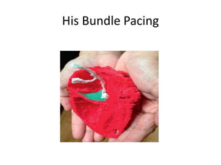 His Bundle Pacing
 