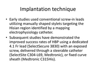 Selectsecure His bundle pacing | PPTX