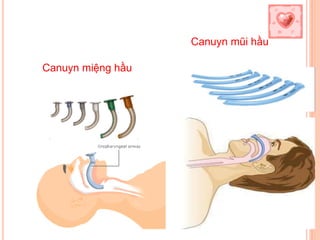 21
Canuyn miệng hầu
Canuyn mũi hầu
 