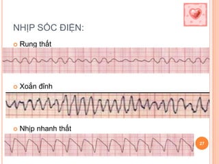 NHỊP SỐC ĐIỆN:
27
 Rung thất
 Xoắn đỉnh
 Nhịp nhanh thất
 