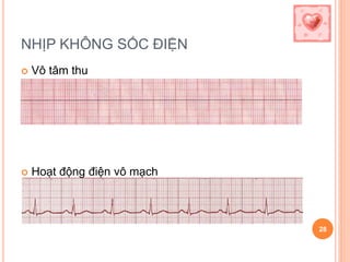 NHỊP KHÔNG SỐC ĐIỆN
 Vô tâm thu
 Hoạt động điện vô mạch
28
 