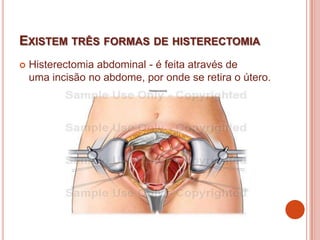 EXISTEM TRÊS FORMAS DE HISTERECTOMIA
 Histerectomia abdominal - é feita através de
uma incisão no abdome, por onde se retira o útero.
 