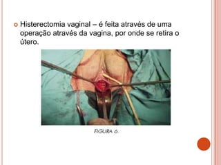 Histerectomia vaginal – é feita através de uma
operação através da vagina, por onde se retira o
útero.
 