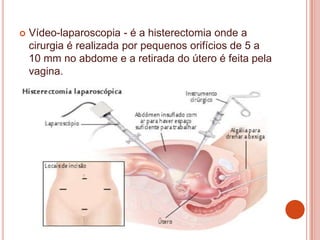  Vídeo-laparoscopia - é a histerectomia onde a
cirurgia é realizada por pequenos orifícios de 5 a
10 mm no abdome e a retirada do útero é feita pela
vagina.
 