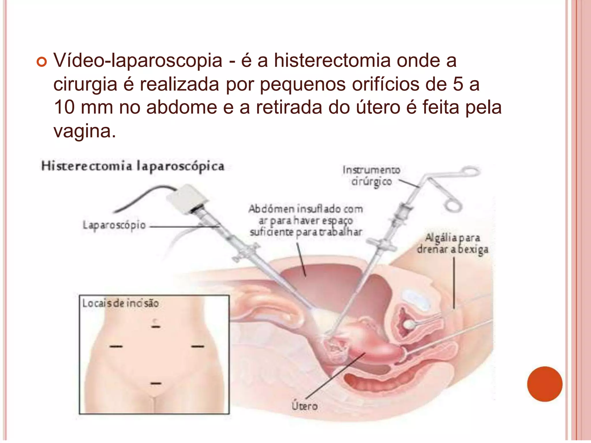 histerectomia.pptx