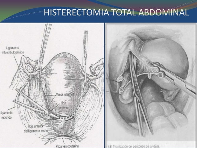Histerectomia total abdominal tecnica quirúrgica