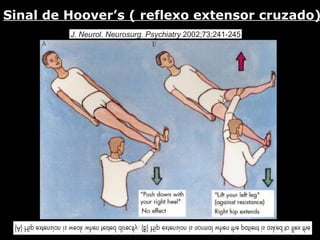 Sinal de Hoover’s ( reflexo extensor cruzado) 