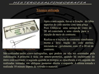HISTEROSSALPINGOGRAFIA Kit para histerossalpingografia com pinça Pozi Após a anti-sepsia, faz-se a fixação  do lábio superior do colo uterino com uma pinça Pozi. Utiliza-se  uma  seringa de  vidro  de  20  ml conectada  a  uma  cânula  para  a  injeção do meio de contraste. Realiza-se a injeção do contraste simultanea-mente  a  leve  tração  do  colo  uterino, iniciando-se , geralmente, com 15 a 20 ml de contraste. São realizadas então, cinco radiografias,  que  podem  ou  não  ser  orientadas  pela radioscopia. A primeira  é  feita  em  antero-posterior,  quando  há  enchimento  do útero com contraste: a segunda quando as trompas se opacificam, e em seguida são realizadas  tomadas  em  obliquas  posterior  direita  e esquerda. A ultima tomada e realizada 10 minuto depois de retirado o material. Técnica utilizada 