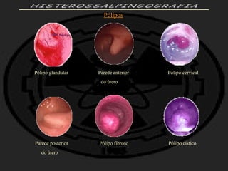 HISTEROSSALPINGOGRAFIA Pólipo glandular  Parede anterior  Pólipo cervical do útero Parede posterior  Pólipo fibroso  Pólipo cístico do útero Pólipos                                     
