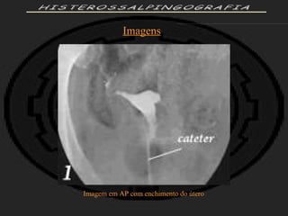 HISTEROSSALPINGOGRAFIA Imagens Imagem em AP com enchimento do útero 