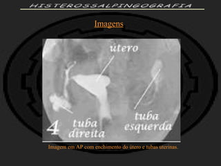 HISTEROSSALPINGOGRAFIA Imagens Imagem em AP com enchimento do útero e tubas uterinas. 