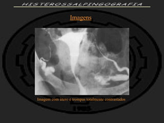 HISTEROSSALPINGOGRAFIA Imagens Imagem com útero e trompas totalmente contrastados 