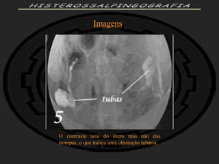 HISTEROSSALPINGOGRAFIA Imagens O contraste saiu do útero mas não das trompas, o que indica uma obstrução tubária. 
