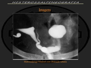 HISTEROSSALPINGOGRAFIA Imagens Hidrossalpinge bilateral com obstrução tubária 