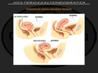 HISTEROSSALPINGOGRAFIA Anatomia do sistema reprodutor feminino 
