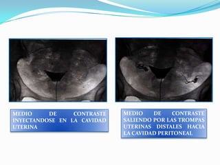 MEDIO
DE
CONTRASTE
INYECTANDOSE EN LA CAVIDAD
UTERINA

MEDIO
DE
CONTRASTE
SALIENDO POR LAS TROMPAS
UTERINAS DISTALES HACIA
LA CAVIDAD PERITONEAL

 