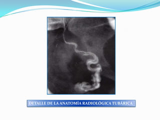 DETALLE DE LA ANATOMÍA RADIOLÓGICA TUBÁRICA

 