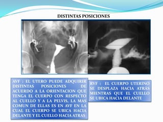 DISTINTAS POSICIONES

AVF : EL UTERO PUEDE ADQUIRIR
DISTINTAS
POSICIONES
DE
ACUERDO A LA ORIENTACION QUE
TENGA EL CUERPO CON RESPECTO
AL CUELLO Y A LA PELVIS, LA MAS
COMUN DE ELLAS ES EN AVF EN LA
CUAL EL CUERPO SE UBICA HACIA
DELANTE Y EL CUELLO HACIA ATRAS

RVF : EL CUERPO UTERINO
SE DESPLAZA HACIA ATRÁS
MIENTRAS QUE EL CUELLO
SE UBICA HACIA DELANTE

 