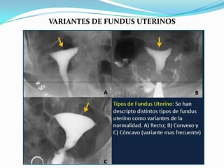VARIANTES DE FUNDUS UTERINOS

 