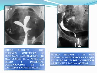 UTERO
BICORNE
:
DOS
CUERNOS
SIMETRICOS
SE
FUSIONAN CAUDALMENTE, LO
MAS COMUN ES A NIVEL DEL
ISTMO
Y
PRESENTAN
COMUNICACIÓN
DE
LAS
CAVIDADES ENDOMETRIALES

UTERO
BICORNE
:
ES
UNA
ANOMALIA ASIMETRICA EN LA QUE
EL UTERO DE UN SOLO CUERNO SE
ABRE EN UNA VAGINA NORMAL

 