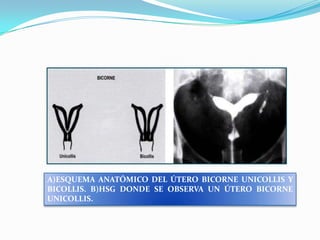 A)ESQUEMA ANATÓMICO DEL ÚTERO BICORNE UNICOLLIS Y
BICOLLIS. B)HSG DONDE SE OBSERVA UN ÚTERO BICORNE
UNICOLLIS.

 