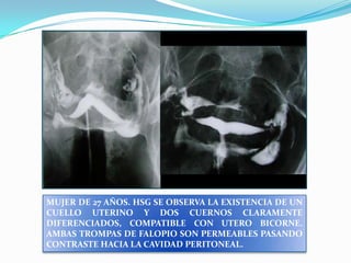 MUJER DE 27 AÑOS. HSG SE OBSERVA LA EXISTENCIA DE UN
CUELLO UTERINO Y DOS CUERNOS CLARAMENTE
DIFERENCIADOS, COMPATIBLE CON UTERO BICORNE.
AMBAS TROMPAS DE FALOPIO SON PERMEABLES PASANDO
CONTRASTE HACIA LA CAVIDAD PERITONEAL.

 