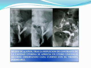 MUJER DE 25 AÑOS. TRAS LA REPLECION DE CONTRASTE DE
LA CAVIDAD UTERINA SE APRECIA UN UTERO UNICOLLIS
BICORNE OBSERVANDO CADA CUERNO CON SU TROMPA
PERMEABLE.

 