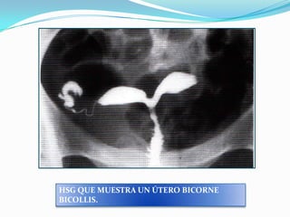 HSG QUE MUESTRA UN ÚTERO BICORNE
BICOLLIS.

 