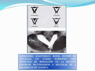 A)ESQUEMA ANATÓMICO. B)HSG DONDE SE
VISUALIZA
UN
ÚTERO
SUBSEPTO
CON
DEFECTOS DE REPLECIÓN EN LA REGIÓN
INFERIOR SECUNDARIOS A SECUELAS DE 2
CICATRICES DE CESÁREA.

 