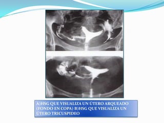 A)HSG QUE VISUALIZA UN ÚTERO ARQUEADO
(FONDO EN COPA) B)HSG QUE VISUALIZA UN
ÚTERO TRICUSPIDEO

 