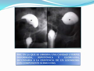 HSG EN LA QUE SE OBSERVA UNA CAVIDAD UTERINA
DEFORMADA,
HIPOTÓNICA
Y
GLOBULOSA,
SECUNDARIA A LA EXISTENCIA DE UN LEIOMIOMA
CON COMPONENTE SUBMUCOSO.

 