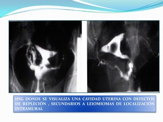 HSG DONDE SE VISUALIZA UNA CAVIDAD UTERINA CON DEFECTOS
DE REPLECIÓN , SECUNDARIOS A LEIOMIOMAS DE LOCALIZACIÓN
INTRAMURAL

 