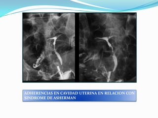 ADHERENCIAS EN CAVIDAD UTERINA EN RELACION CON
SINDROME DE ASHERMAN

 