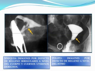 SINEQUIA: IMÁGENES POR DEFECTO
DE RELLENO IRREGULARES A NIVEL
DEL CUERPO Y CUERNOS UTERINOS
DERECHOS.

POLIPO:
IMÁGENES
POR
DEFECTO DE RELLENO A NIVEL
DEL ISTMO

 
