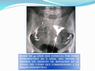 MUJER DE 40 AÑOS QUE CONSULTA POR DESEO
REPRODUCTIVO DE 8 AÑOS. HSG DONDE SE
OBSERVA UN DEFECTO DE REPLECION EN EL
FONDO DEL UTERO QUE CORRESPONDIO A UN
POLIPO ENDOMETRIAL

 