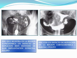 HSG QUE MUESTRA EN LA REGION
SUPRAISTMICA UN DEFECTO DE
REPLECION BIEN DEFINIDO DE
BASE IMPLANTACION ESTRECHA.
POLIPO

HSG CON UN DEFECTO DE REPLECION
EN LA REGION CERVICOISTMICA (
FLECHA ). POLIPO

 