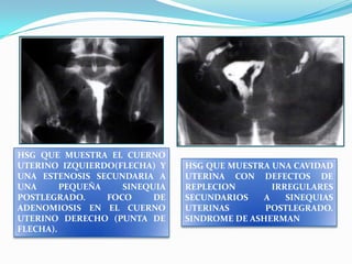 HSG QUE MUESTRA EL CUERNO
UTERINO IZQUIERDO(FLECHA) Y
UNA ESTENOSIS SECUNDARIA A
UNA
PEQUEÑA
SINEQUIA
POSTLEGRADO.
FOCO
DE
ADENOMIOSIS EN EL CUERNO
UTERINO DERECHO (PUNTA DE
FLECHA).

HSG QUE MUESTRA UNA CAVIDAD
UTERINA CON DEFECTOS DE
REPLECION
IRREGULARES
SECUNDARIOS
A
SINEQUIAS
UTERINAS
POSTLEGRADO.
SINDROME DE ASHERMAN

 