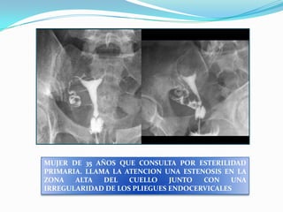 MUJER DE 35 AÑOS QUE CONSULTA POR ESTERILIDAD
PRIMARIA. LLAMA LA ATENCION UNA ESTENOSIS EN LA
ZONA
ALTA
DEL
CUELLO
JUNTO
CON
UNA
IRREGULARIDAD DE LOS PLIEGUES ENDOCERVICALES

 