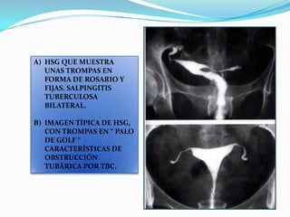 A) HSG QUE MUESTRA
UNAS TROMPAS EN
FORMA DE ROSARIO Y
FIJAS. SALPINGITIS
TUBERCULOSA
BILATERAL.
B) IMAGEN TÍPICA DE HSG,
CON TROMPAS EN “ PALO
DE GOLF “
CARACTERÍSTICAS DE
OBSTRUCCIÓN
TUBÁRICA POR TBC.

 